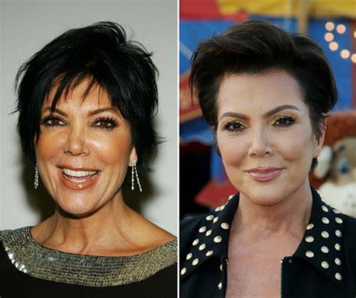 Kris Jenner Plastic Surgery Lips